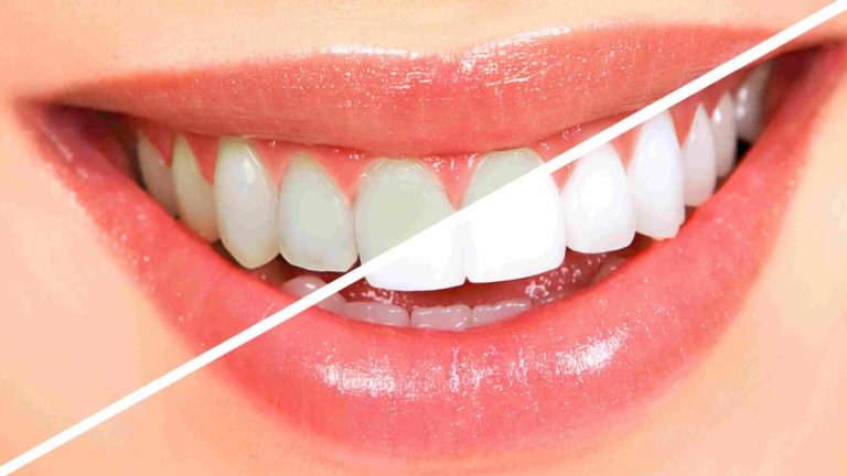 Dites adieu aux dents tachées avec cette méthode simple et efficace