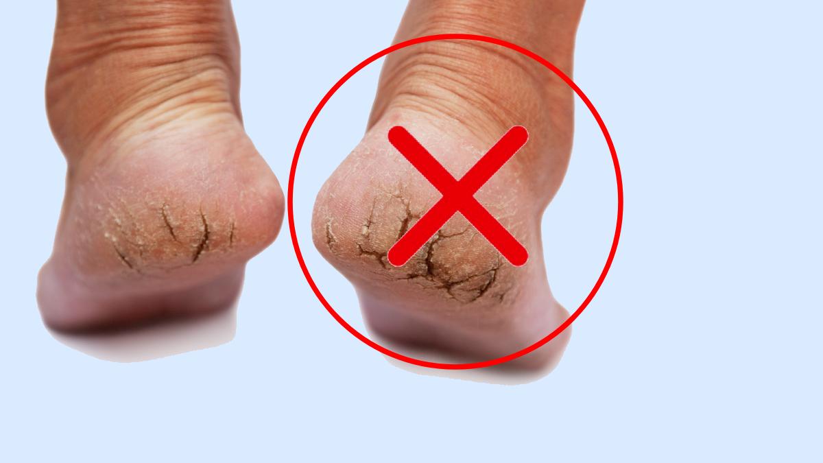 Adieu cornes aux pieds : découvrez cette astuce de grand-mère qui fait des miracles