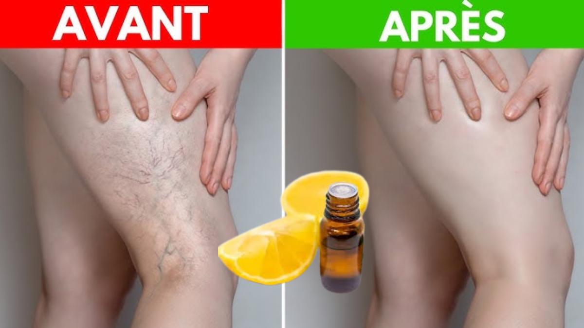 Varices : Vous devez absolument essayer ce remède au citron 100 % naturel