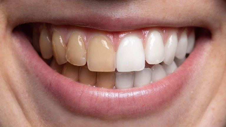 Cette astuce pour blanchir les dents en 2 minutes va vous surprendre par son efficacité