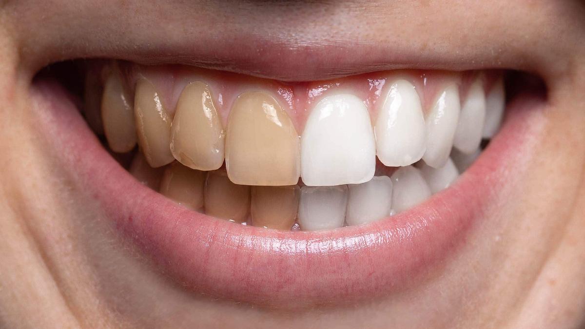 Cette astuce pour blanchir les dents en 2 minutes va vous surprendre par son efficacité